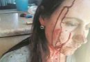 4 Pics: S.Africa: White Female teacher attacked viciously by Black Student: NO OUTRAGE